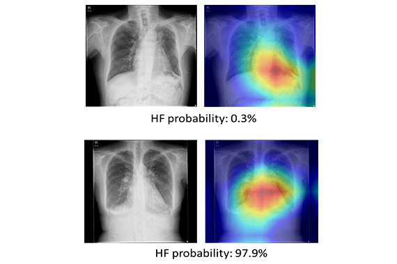 A research group led by Professor Junichi Kotoku has developed artificial intelligence (AI) using plain chest X-ray images that can predict the prognosis of heart failure patients.